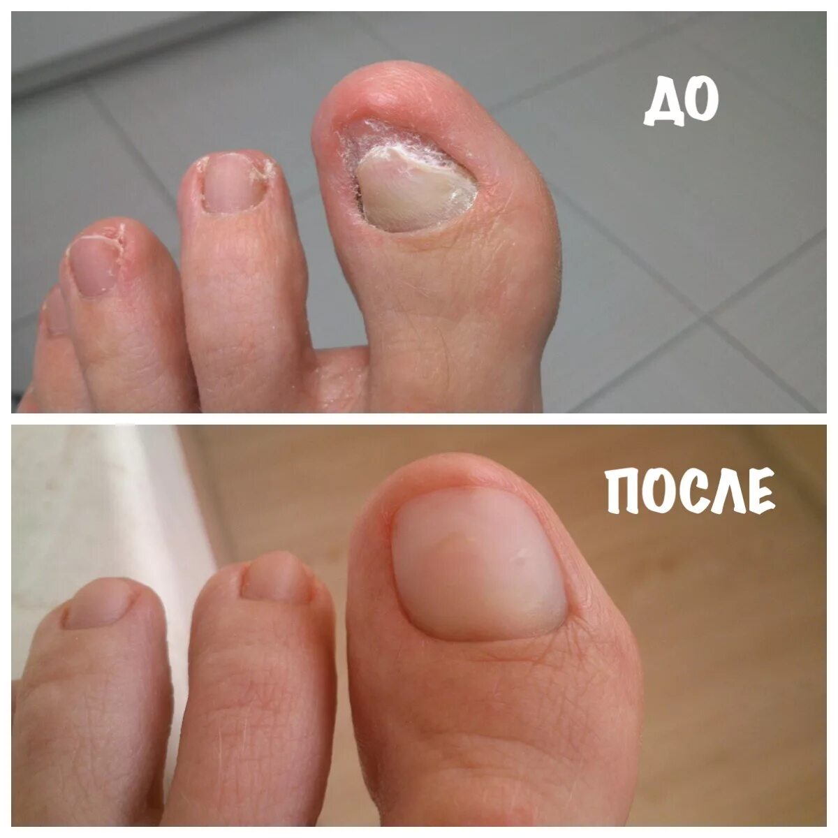 Что делать после снятия ногтя. Ониходистрофия - онихолизис.. Протезирование ногтей на ногах. Протезирование ногтевой пластины на ногах.
