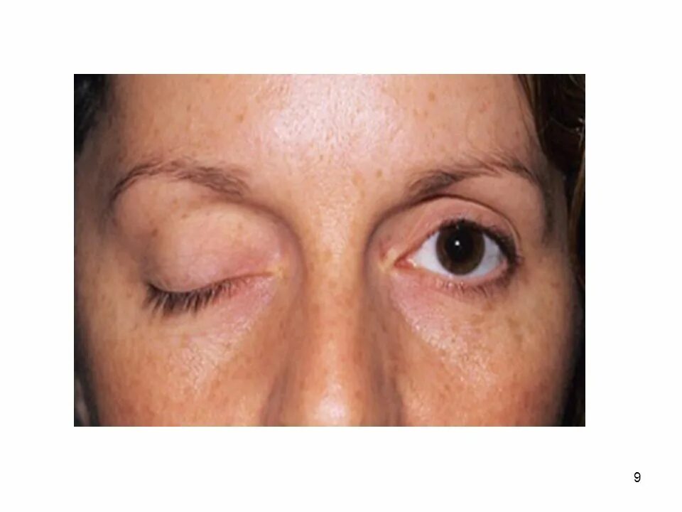 глазная миастения гравис. миастения гравис глазная форма. миастения это аутоиммунное заболевание. глазная миастения. псевдопаралитическая миастения.