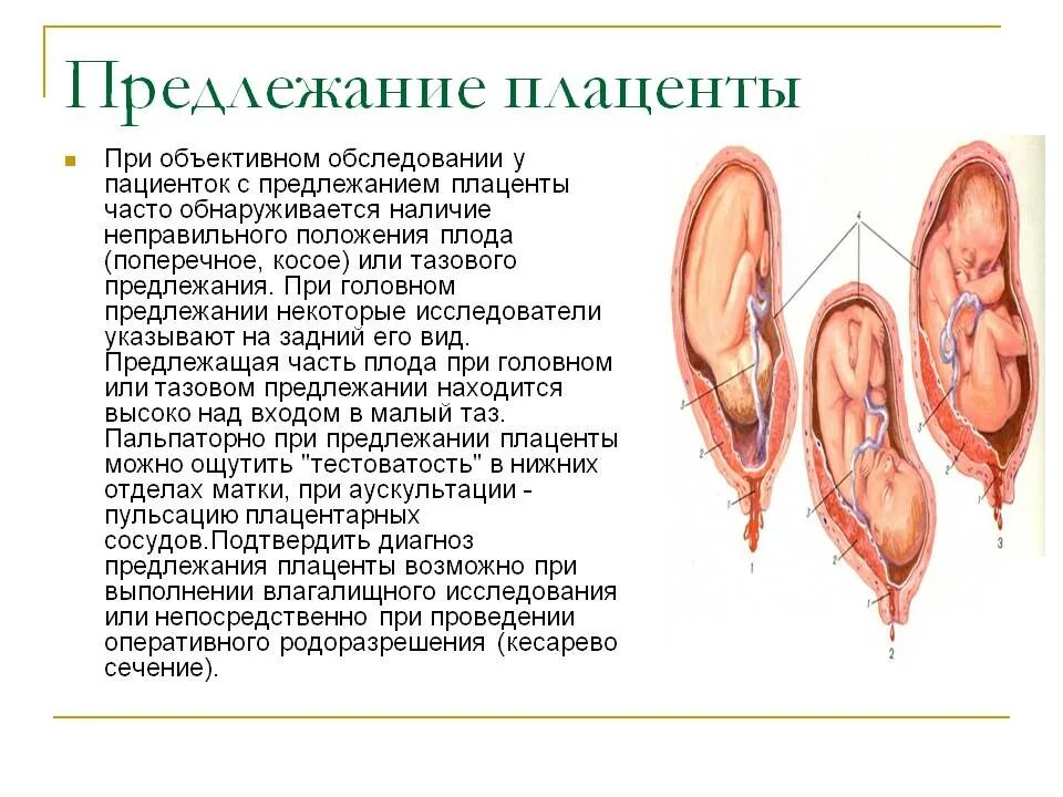 При низкой плацентации можно. Предлежание плаценты головное. Краевое боковое центральное низкое предлежание плаценты. Неправильное предлежание плаценты. Плодовый фактор предлежания плаценты.