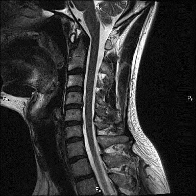 Мрт спинного отдела. Мрт шейного отдела позвоночника. Грыжа шейного отдела мрт. Мрт шейного отдела норма. Мрт шейного отдела позвоночника норма.