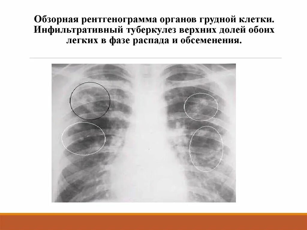 Тени в верхней доле легкого. Инфильтративный туберкулез рентгенография. Казеозная пневмония туберкулез. Инфильтративный туберкулез рентгенограмма. Рентген инфильтративного туберкулеза.