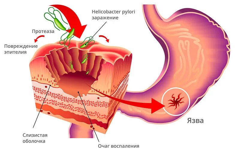 Фолликулярный бульбит. Хеликобактер пилори язва. Язва желудка хеликобактер пилори. Каллезная язва желудка и 12-перстной кишки.