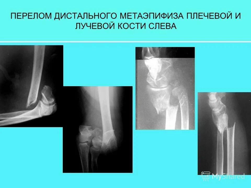 Переломы дистального метаэпифиза плечевой кости классификация. Вколоченный перелом дистального эпифиза лучевой кости. Перелом дистального метаэпифиза локтевой кости. Поперечный перелом метаэпифиза лучевой кости. Перелом дистального эпифиза лучевой кости рентген.