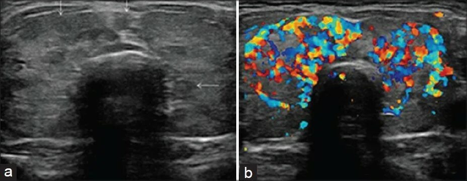 Диффузный зоб узи. Диффузный зоб узи. Диффузно -узловой зов узи. Многоузловой токсический зоб узи. Диффузный зоб узи.