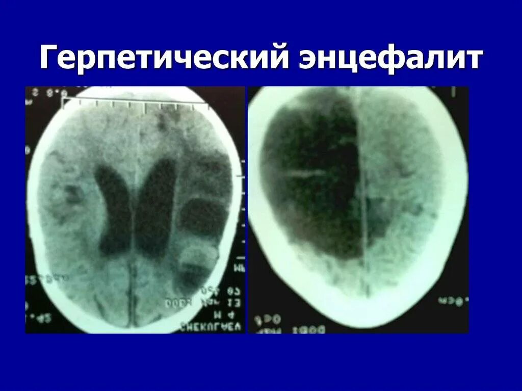 Герпетический энцефалит кт головного мозга. Острый герпетический менингоэнцефалит. Герпетический энцефалит головного мозга симптомы. Энцефалит головного мозга у взрослых