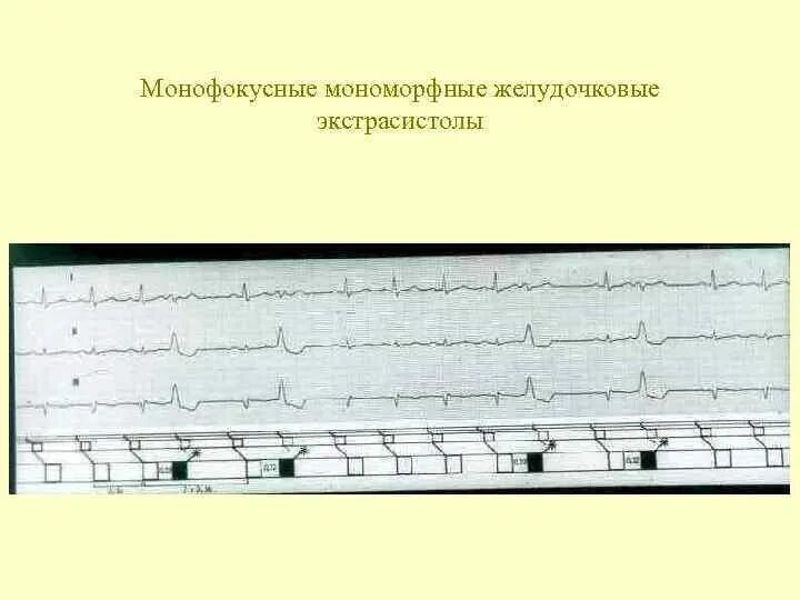 Желудочковые мономорфные экстрасистолы экг. Политопная полиморфная желудочковая экстрасистолия. Пируэтная желудочковая тахикардия. Мономорфная желудочковая экстрасистолия. Мономорфная желудочковая экстрасистолия.