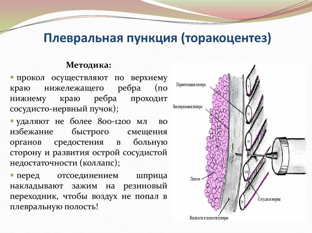 Плевральная пункция (торакоцентез). Методика пункции плевральной полости. Плевральная пункция гидроторакс. Торакоцентез методика. Точка пункции плевральной полости при пневмотораксе.