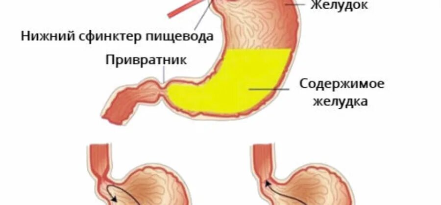 Симптомы заброса желчи в желудок и пищевод. От заброса желчи в желудок. Симптомы желчи в пищеводе