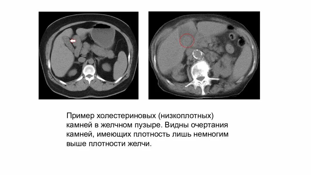 Камни на кт видны. Холестериновые конкременты желчного пузыря кт. Плотность конкрементов желчного пузыря кт. Камни желчного пузыря на кт. Холестериновые камни в желчном пузыре на кт.