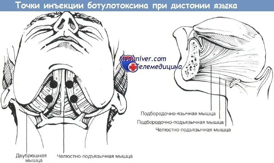Внутримышечная инъекция техника угол иглы. Уколы для расслабления челюсти. Техника введения вакцины адсм под лопатку. Введение иглы при внутримышечной инъекции. Техника подъязычного введения лекарственных средств.
