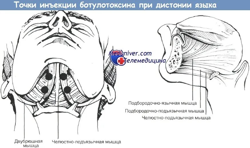 Укол под язык техника выполнения. Введение адреналина в корень языка. Точка уколова