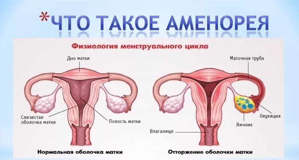 Удаление матки будут ли месячные. Отсутствие менструации. Аменорея это отсутствие месячных. Как происходит менструация.