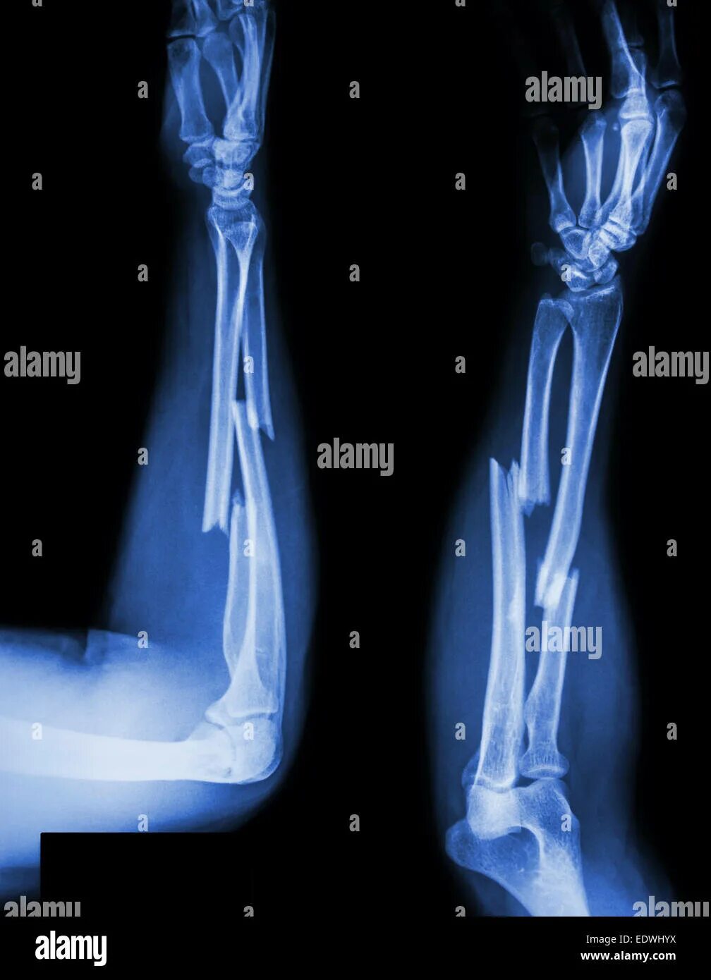Radius fracture