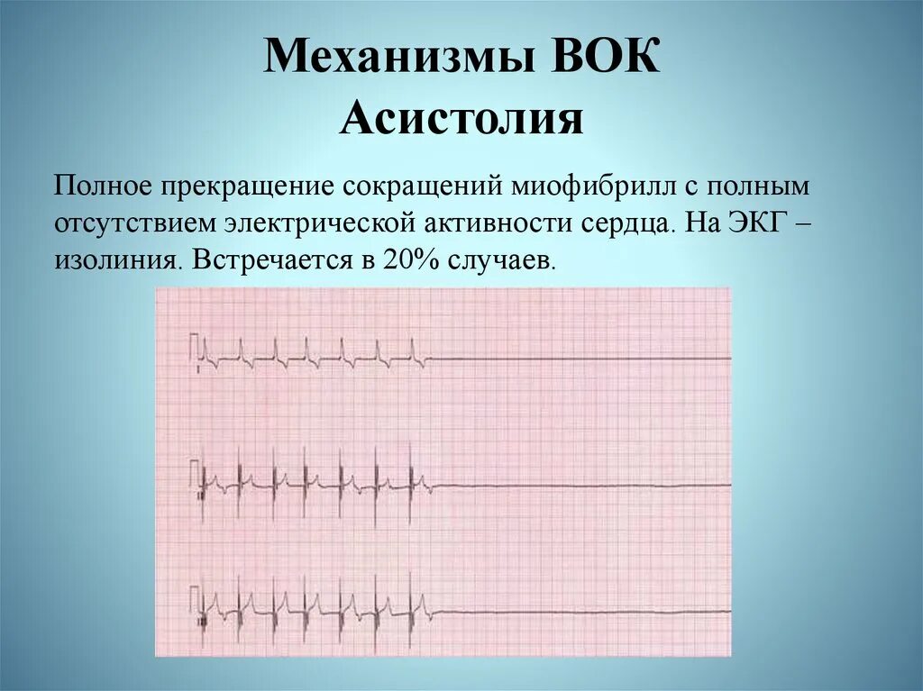 Изолиния на ЭКГ. Изоэлектрическая линия на ЭКГ это. Изолиния на ЭКГ асистолия. Изолиния на кардиограмме.