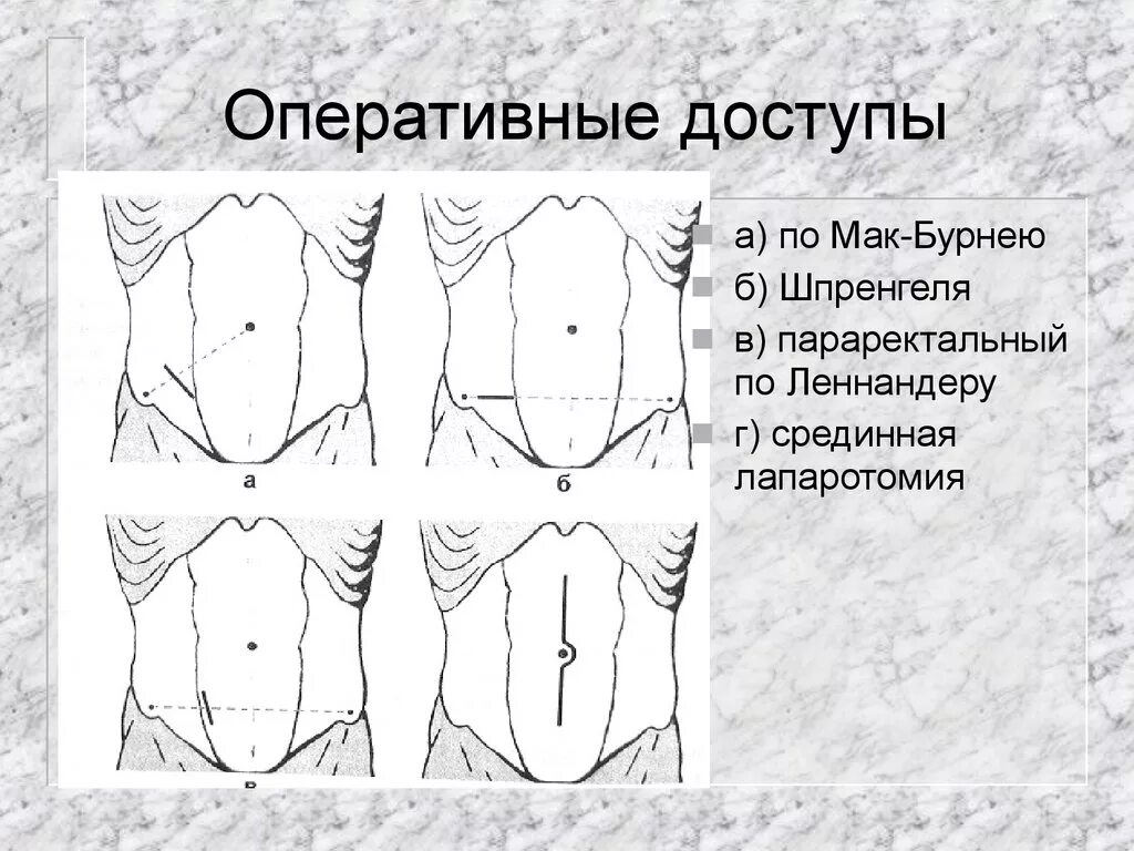 Хирургические доступы при остром аппендиците. Аппендэктомия Шпренгеля. Мак Бурнея Волковича Дьяконова. Операционные доступы при остром аппендиците. Нижняя лапаротомия