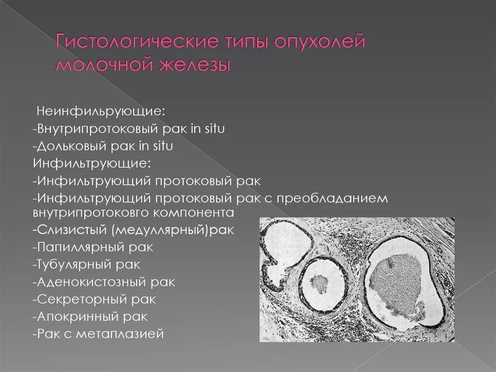 Классификация опухолей молочной железы гистология. Карцинома молочной железы in si. Гистологический Тип опухоли молочной железы. Локализация опухоли в молочной железе. Рак молочной железы жизнь после