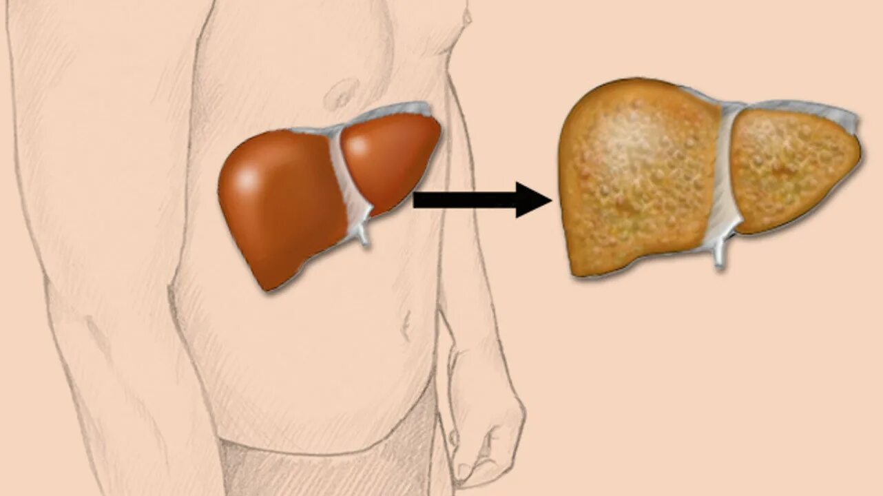 Чем опасна жировая печень. Жировой гепатоз (стеатоз) печени.