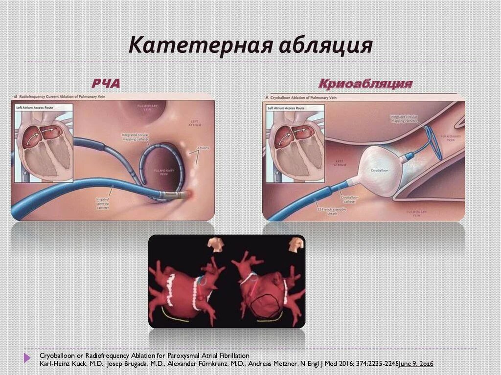 Где делают абляцию. Радиочастотная катетерная абляция сердца. Радиочастотная катетерная абляция методика проведения. Катетерная деструкция. Катетерная абляция сердца что это такое.