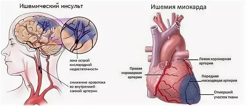 При инфаркте давление повышается или. При инфаркте давление повышается или