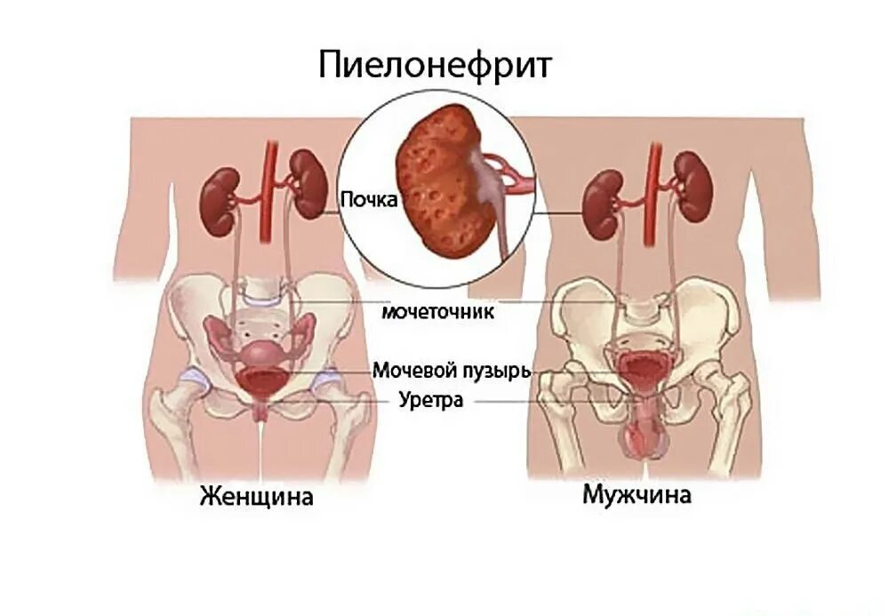 Пелонифри. Болезнь почек пиелонефрит.