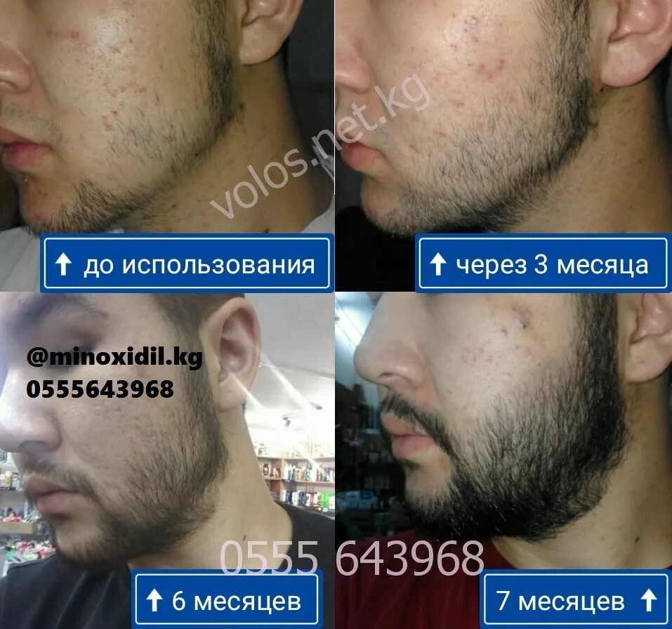 Средство для роста волос бороды. Миноксидил Генеролон для бороды. Minoxidil Kirkland 5 для бороды. Миноксидил 5 % alerana для бороды. Генеролон миноксидил 5 для бороды.