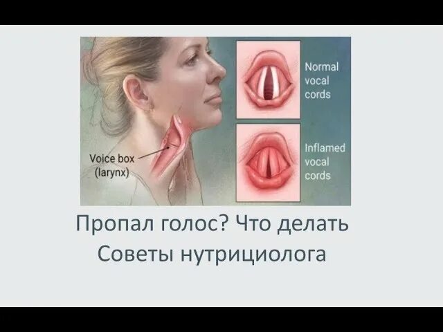 Ломается голос болит горло. Пропавший голос. Ломается голос болит горло. От осиплости голоса. Связки голосовые и охрипший голос.