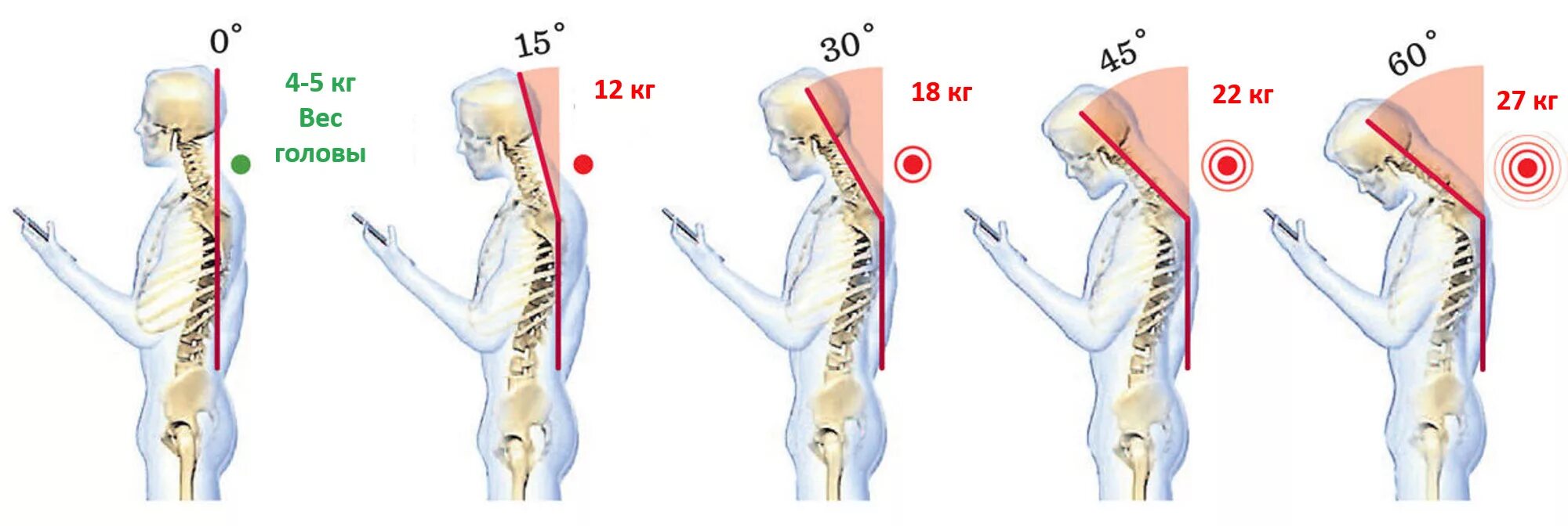 Сколько дают за голову. Нагрузка на шею при наклоне головы. Нагрузка на позвоночник в зависимости от наклона головы. Статическая нагрузка на позвоночник. Нагрузка на позвоночник при наклоне головы.