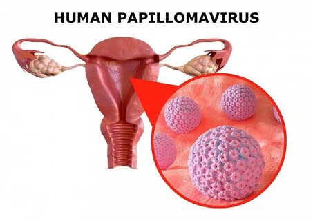 Fotogalerie: HPV, rakovina děložního čípku - Deník.cz