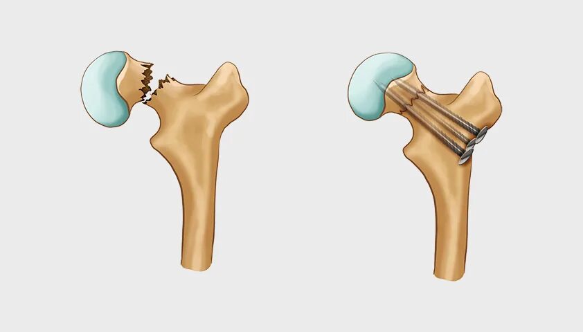 Шейка бедра у мужчин. Перелом шейки бедра остеосинтез. Перелом шейки бедра операция. Металлоостеосинтез тазобедренного сустава. Металлоостеосинтез шейки бедра.