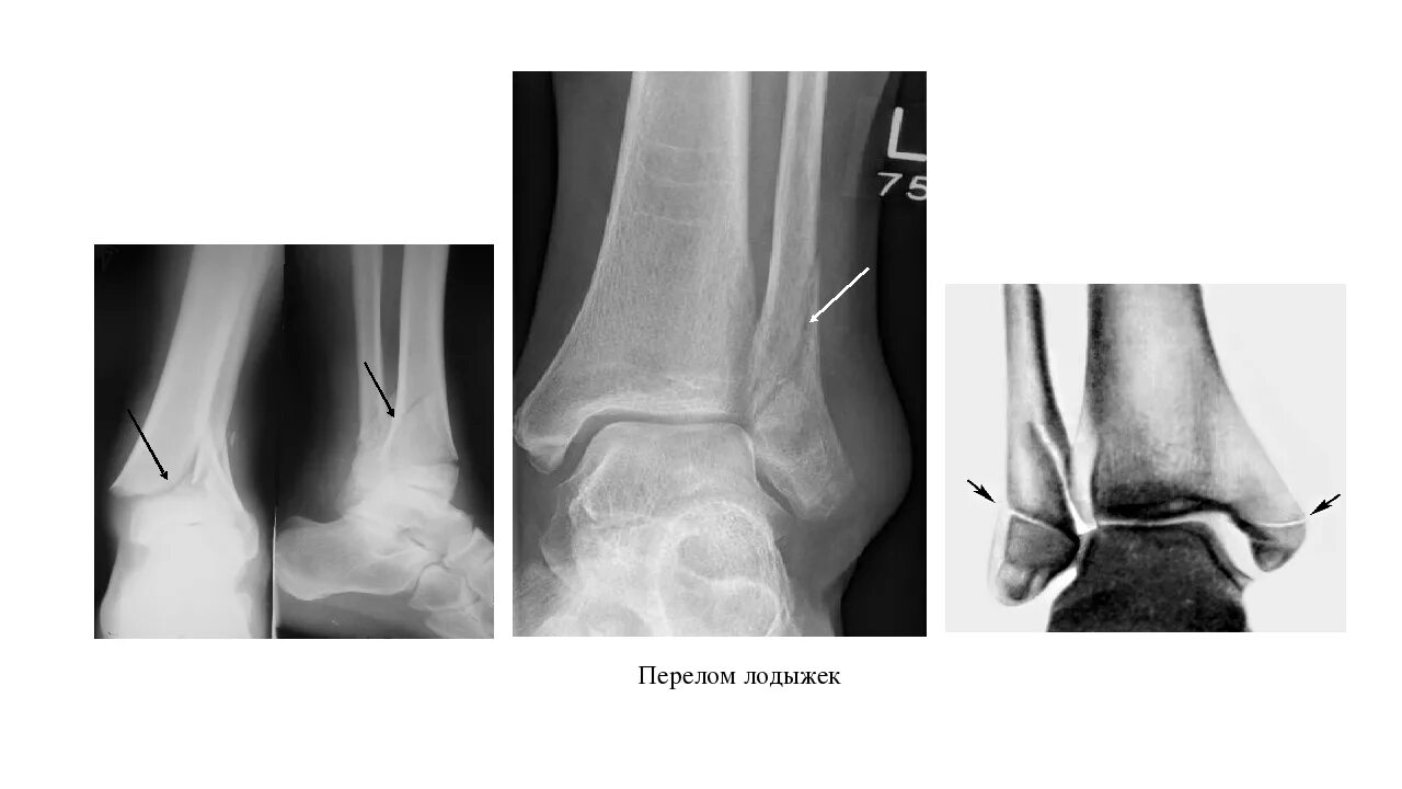 Пронационный перелом лодыжки. Апикальный перелом лодыжки. Абдукционный перелом лодыжки. Перелом лодыжки трехлодыжечный перелом.