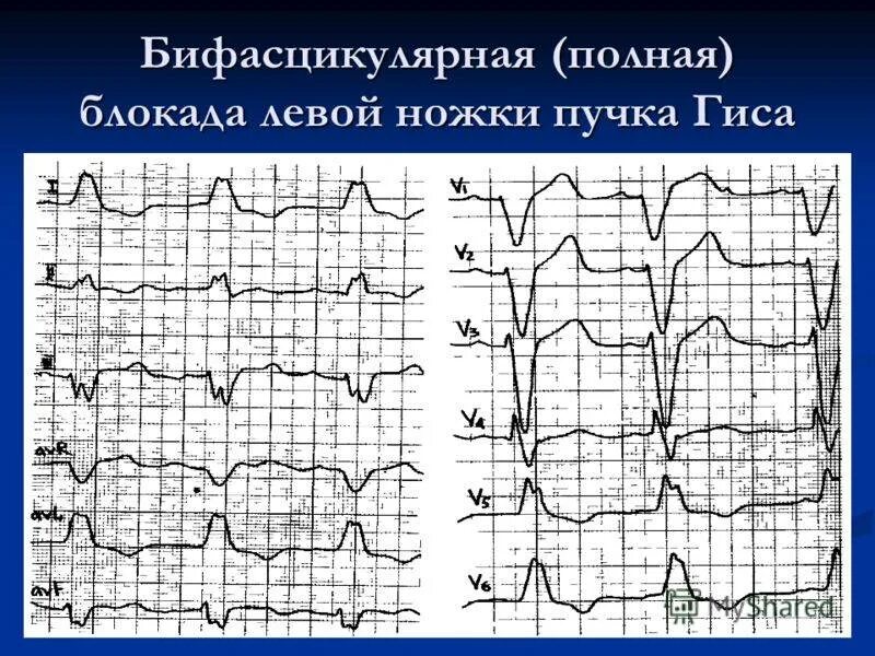 Блокада задней ножки. ЭКГ полная блокада левой ножки пучка Гиса ЭКГ. Блокада левой ножки пучка Гиса (нарушение проводимости) ЭКГ. ЭКГ критерии блокады левой ножки пучка Гиса. ЭКГ при блокадк левой нодки пучк Агиса.