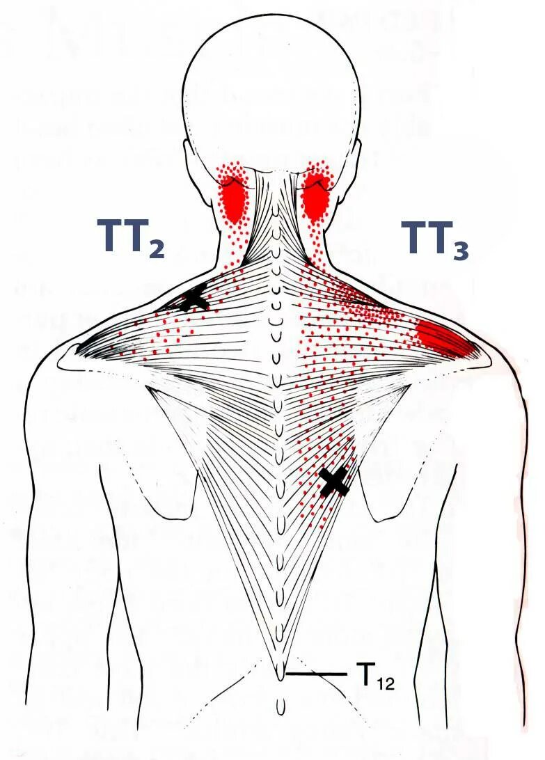 Триггерные зоны трапециевидной мышцы. Триггерные точки трапеции. Триггерные точки верхней трапеции.