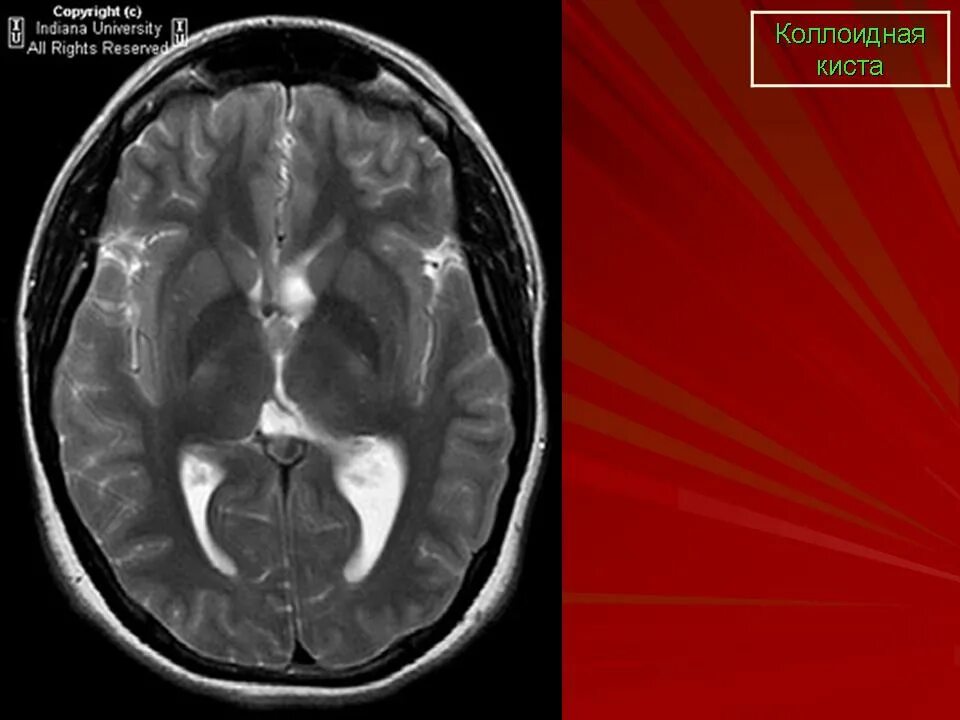 Коллоидная киста головного мозга на кт. Коллоидная киста головного мозга мрт. Коллоидная киста 3 желудочка головного мозга. Коллоидная киста ГМ кт. Киста головного мозга армия