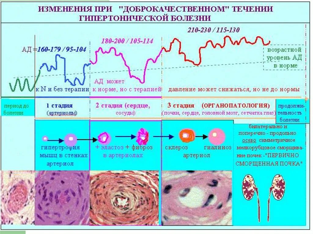 Изменения в течение болезни. Морфологические стадии гипертонической болезни. Патологическая анатомия стадий гипертонической болезни. Гипертоническая болезнь изменение сосудов. Изменения в органах при гипертонической болезни.