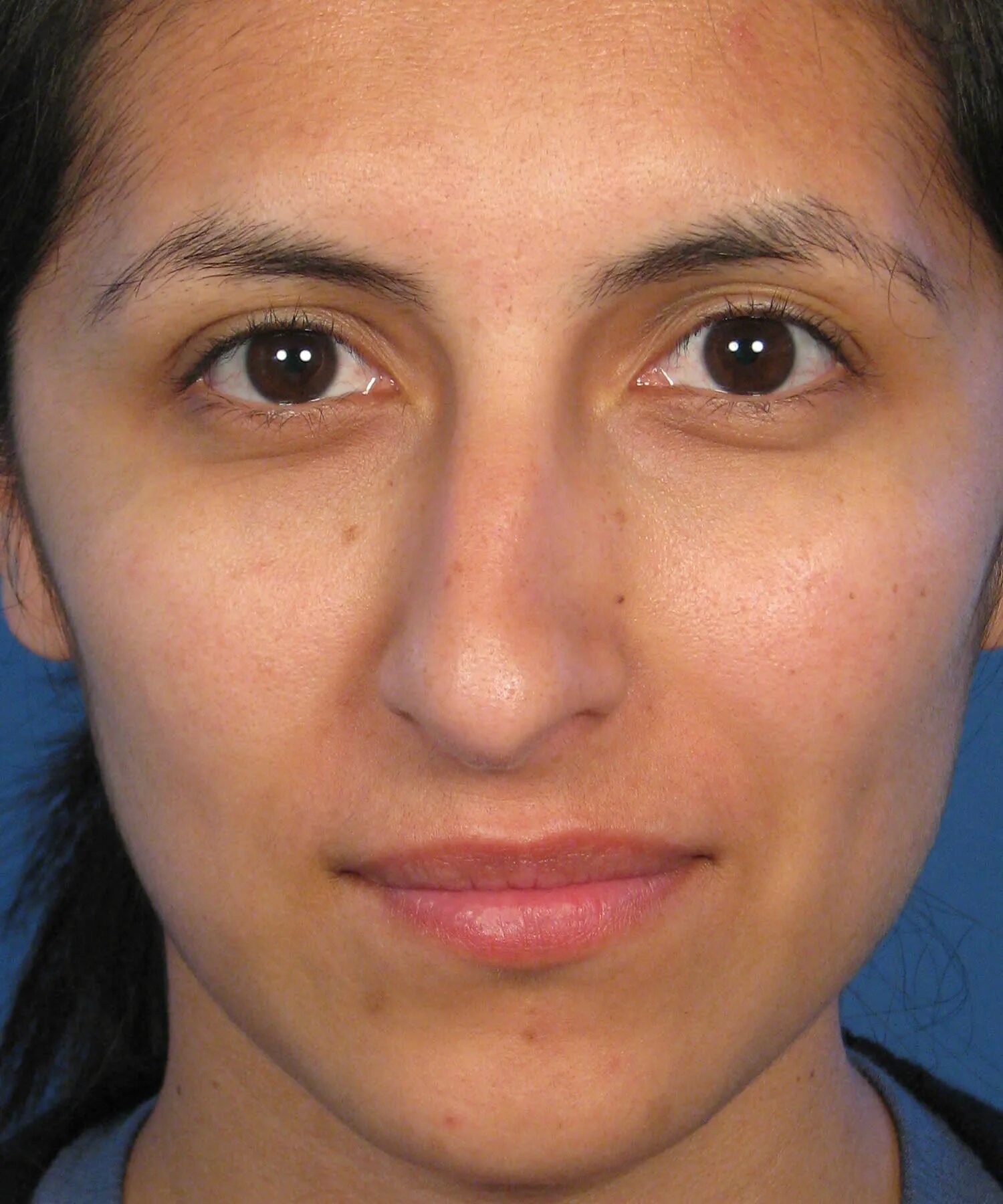 кривой нос одна сторона. кривой нос одна сторона. нижнелицевая асимметрия. исправление асимметрии лица. исправление асимметрии лица.