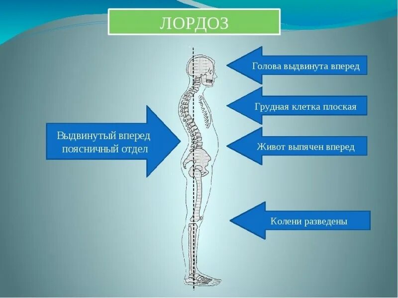 Поясничный лордоз что это такое