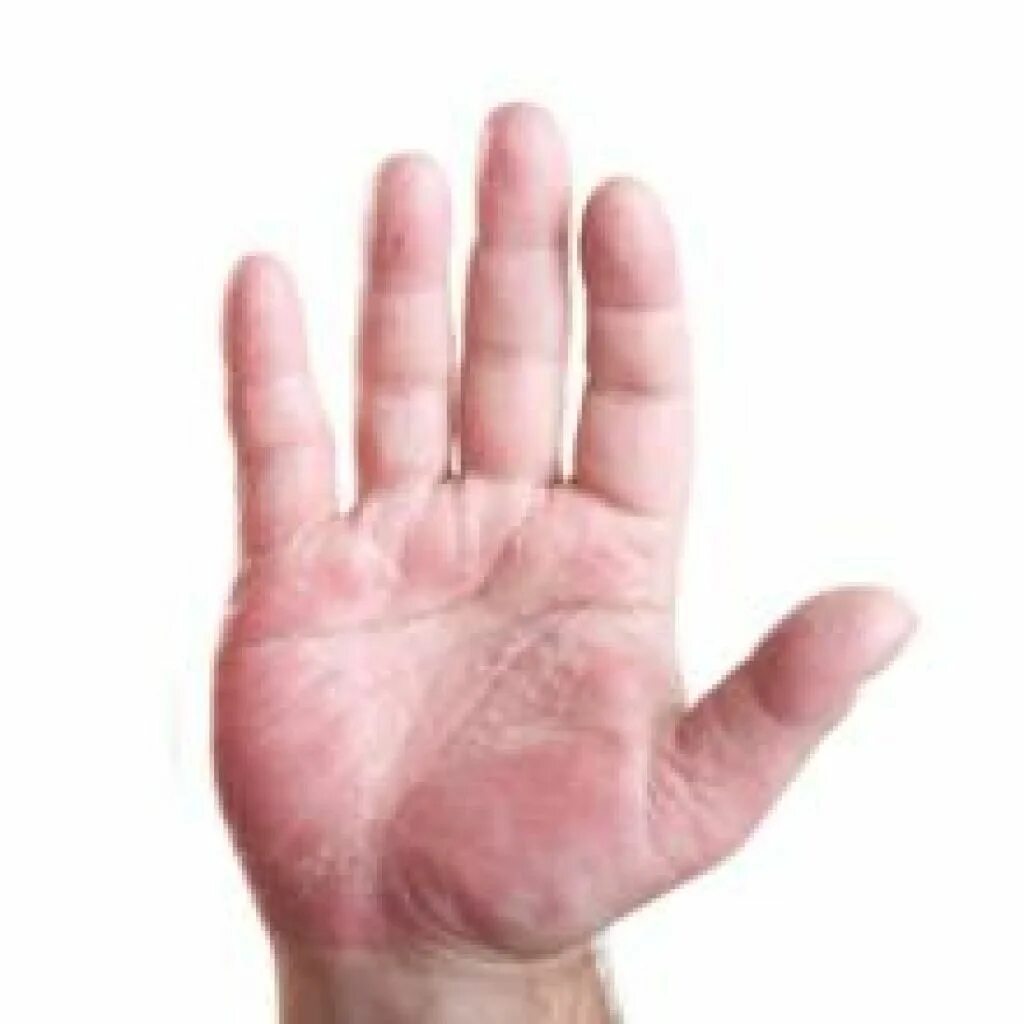 Аллергия на латексные перчатки. От перчаток раздражение. Реакция на латексные перчатки. Аллергический дерматит на руках. Фруктово-латексная аллергия.