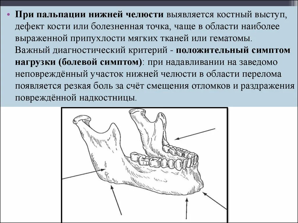 Изоляция костных выступов верхней и нижней челюсти. Двойной перелом нижней челюсти. Нижняя челюсть кость. Костные выступы в челюсти.