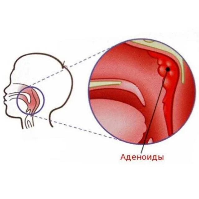 Аденоиды у ребенка 2 3 лет. Отечно-катаральный аденоидит.