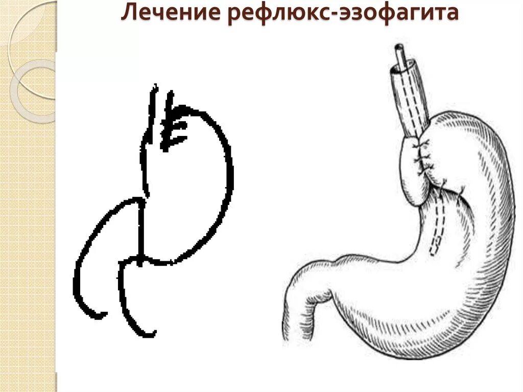 Лекарство от эзофагита