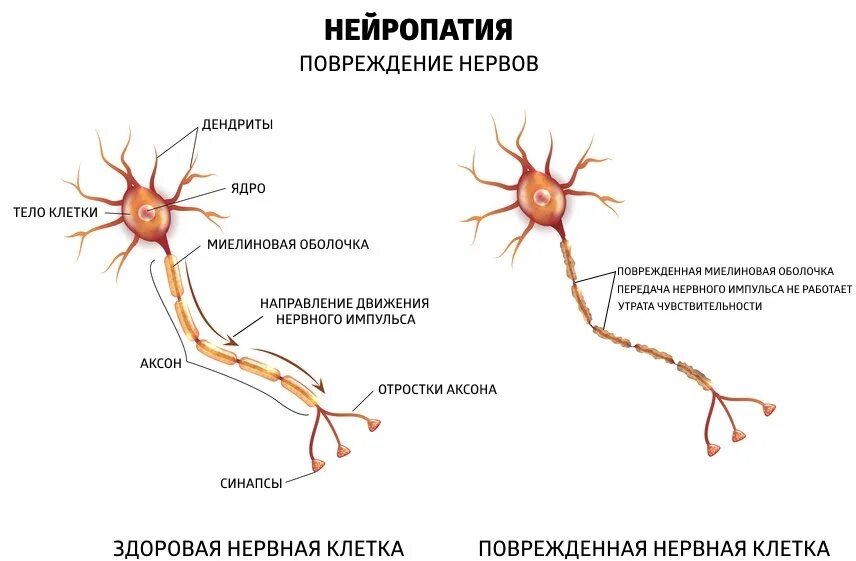 Периферическая сенсорная нейропатия. Нейропатия периферических нервов. Диабетическая периферическая нейропатия. Этиология полинейропатии. Нейропатия правого нерва