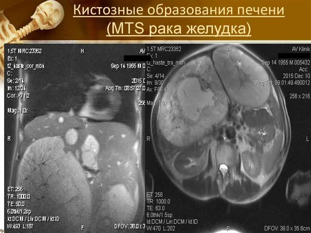 Кистозное образование печени. Кистозное образование. Кистозные образования печени. Образования печени мрт.