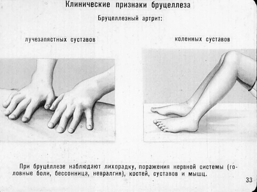 Что за болезнь бруцеллез у человека симптомы. Основные клинические симптомы острого бруцеллеза. Бруцеллез хроническая форма у людей симптомы. Бруцеллез симптомы клиническая картина у человека лечение. Основные клинические симптомы бруцеллёзе.