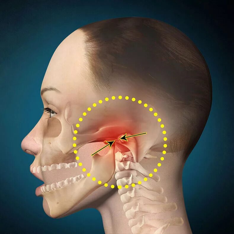 Сильные височные боли. Артроз челюстно-лицевого сустава. Артроз височно челюстного сустава. Челюстью(дисфункция ВНЧС).