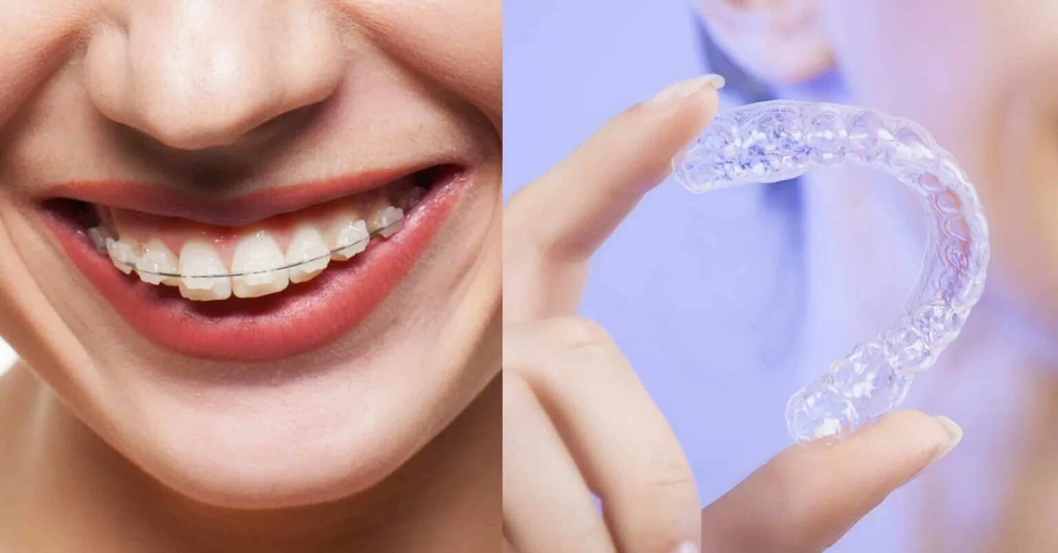 Элайнеры это. Каппы инвизилайн. элайнеры 2025. элайнеры invisalign. невидимые брекеты инвизилайн.