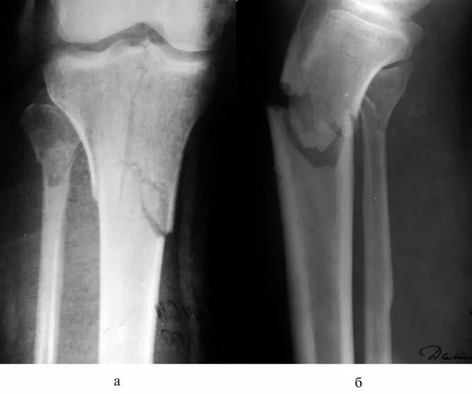 Чрезмыщелковый перелом большеберцовой кости. Эпифизарный внутрисуставной перелом. Внутрисуставные переломы коленного сустава рентген. Многооскольчатый чрезмыщелковый перелом большеберцовой кости.
