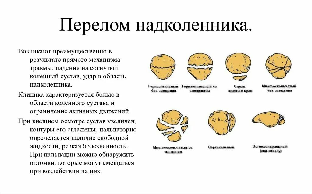 Закрытый краевой перелом надколенника. Проделный перелом надколенников. Краевой вертикальный перелом надколенника. Переломы надколенника классификация. Перелом надколенника операции