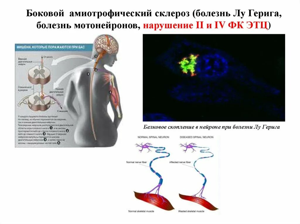 Боковой амиотрофический склероз причины заболевания. Боковой амиотрофический склероз патогенез. Боково́й (латера́льный) амиотрофи́ческий склеро́з. Амиотрофический латеральный склероз. Боковым амиотрофическим склерозом — болезнью Лу Герига..