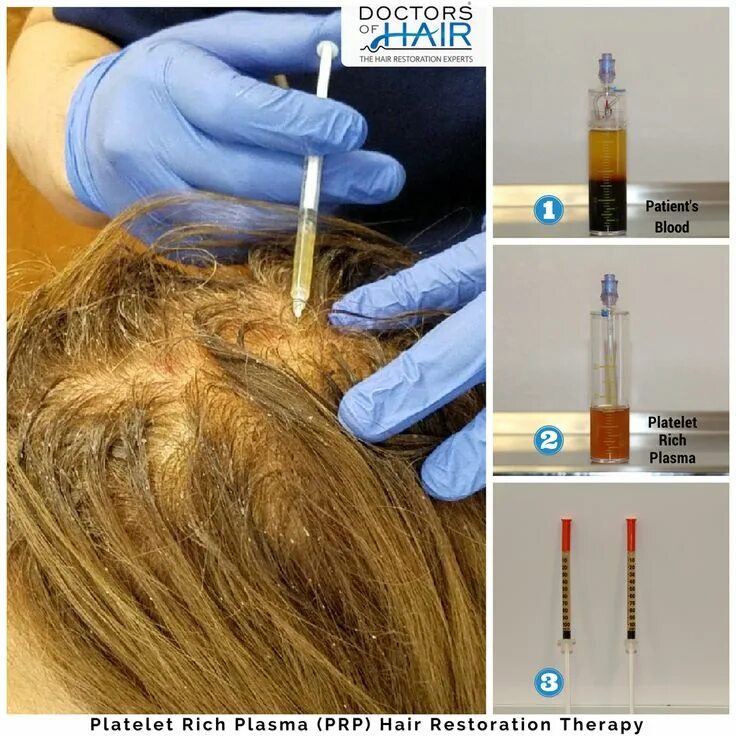 Pin by AMARA Medical on MD MedSpa in 2020 Prp for hair loss, Platelet rich plasm