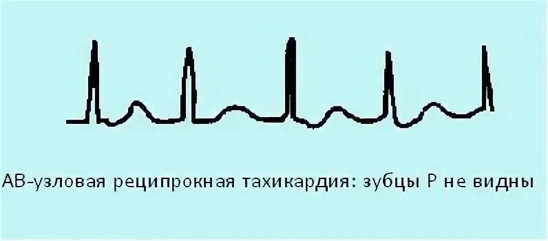 Тахикардия операция